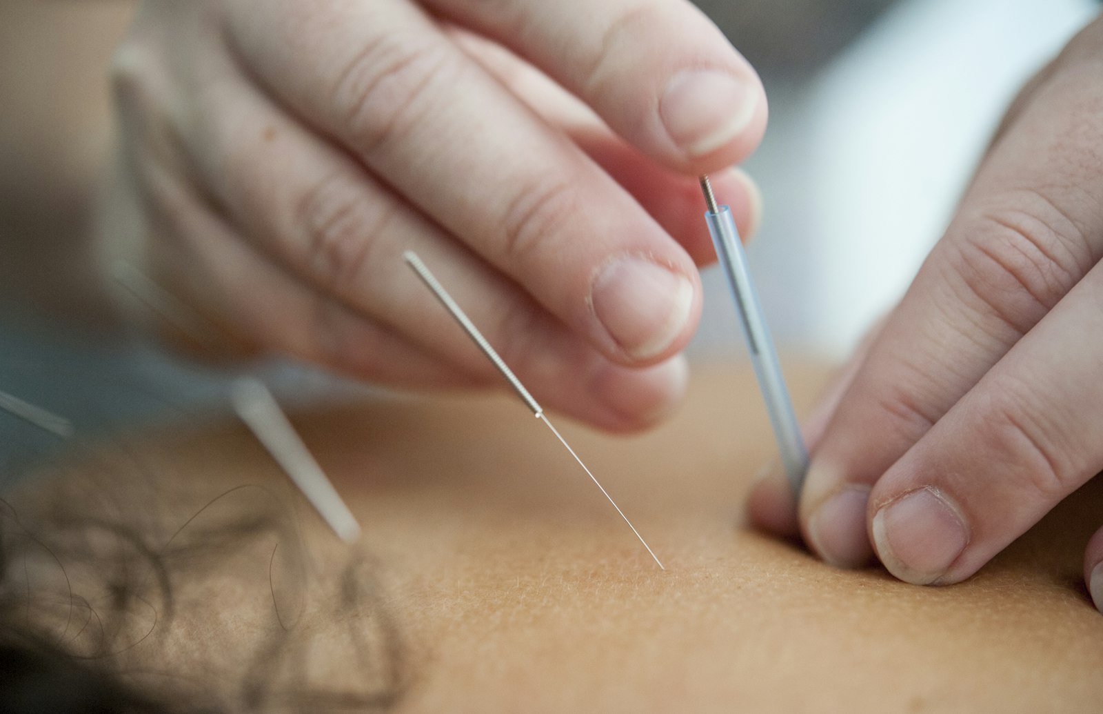 Sessão de acupuntura aplicada nas costas
